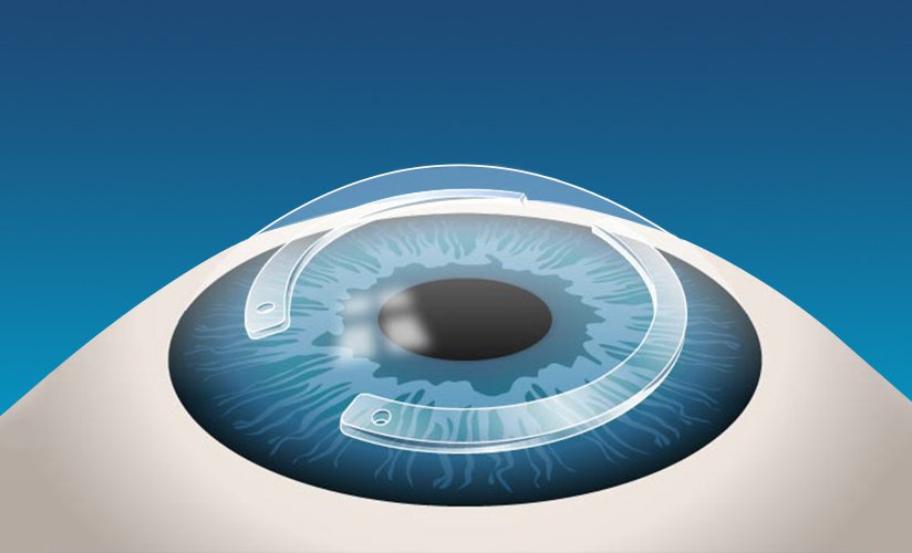 عمليات القرنية